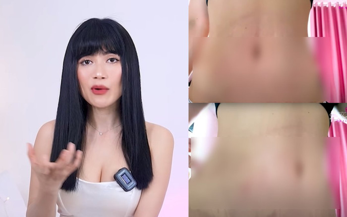 Sĩ Thanh gây choáng khi tiết lộ đeo nịt bụng 7 năm đến mức bị lở loét, thâm đen Ảnh 2