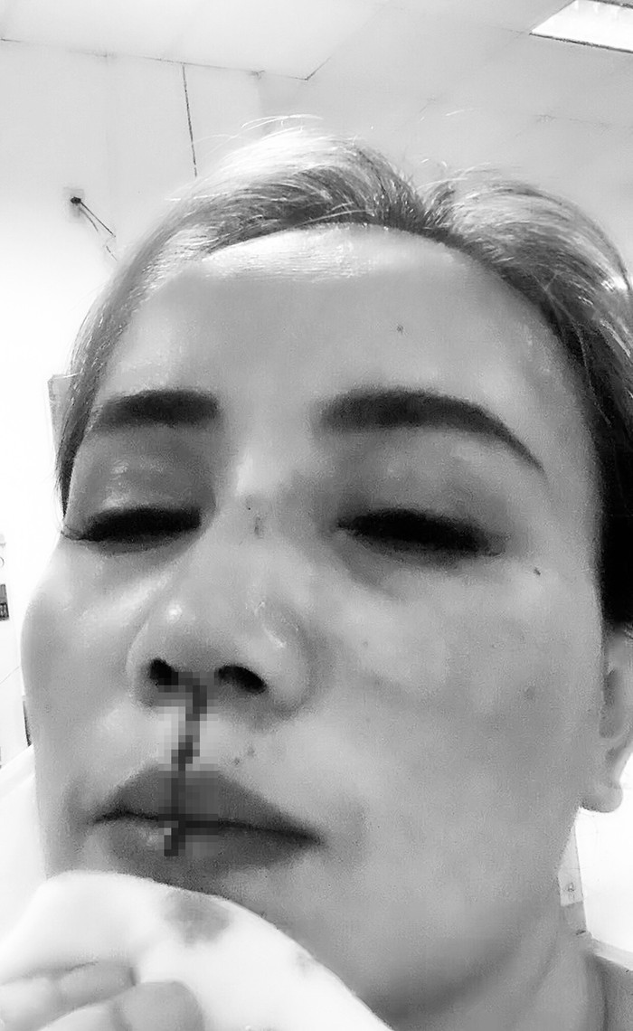 Hoàng Yến chia sẻ thương tích sau khi bị chồng cũ đánh.