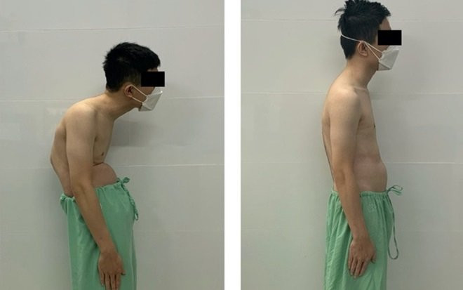 Phẫu thuật nắn cột sống cho nam thanh niên bị còng sau tai nạn giao thông Ảnh 2