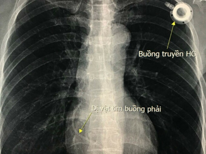 Người phụ nữ bị dị vật trôi theo mạch máu rồi mắc kẹt ở tim Ảnh 1