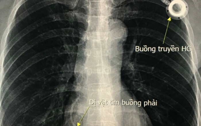 Người phụ nữ bị dị vật trôi theo mạch máu rồi mắc kẹt ở tim Ảnh 2