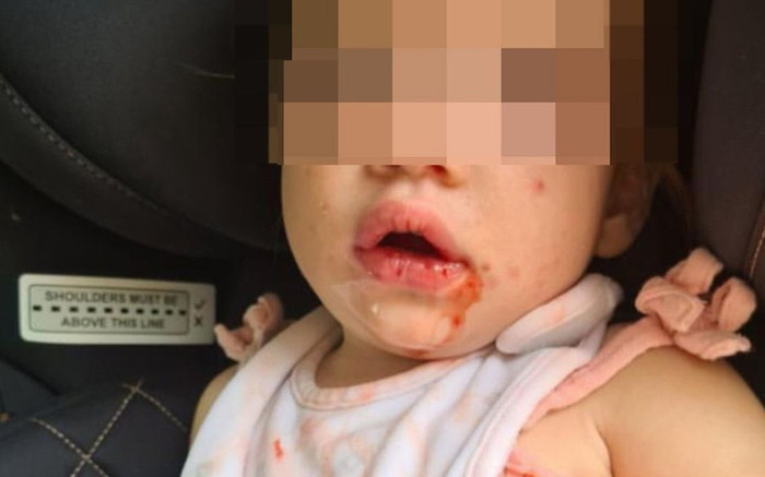 Xót xa bé gái mọc mụn rộp ở miệng, chẳng thể ăn uống, nguyên nhân khiến nhiều người 'giật mình' Ảnh 2