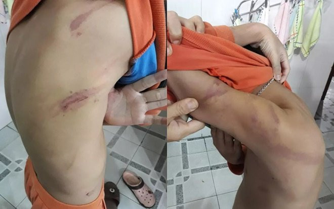 Bé trai 7 tuổi bị cha ruột bạo hành bầm tím cơ thể vì học hành chậm tiến Ảnh 2