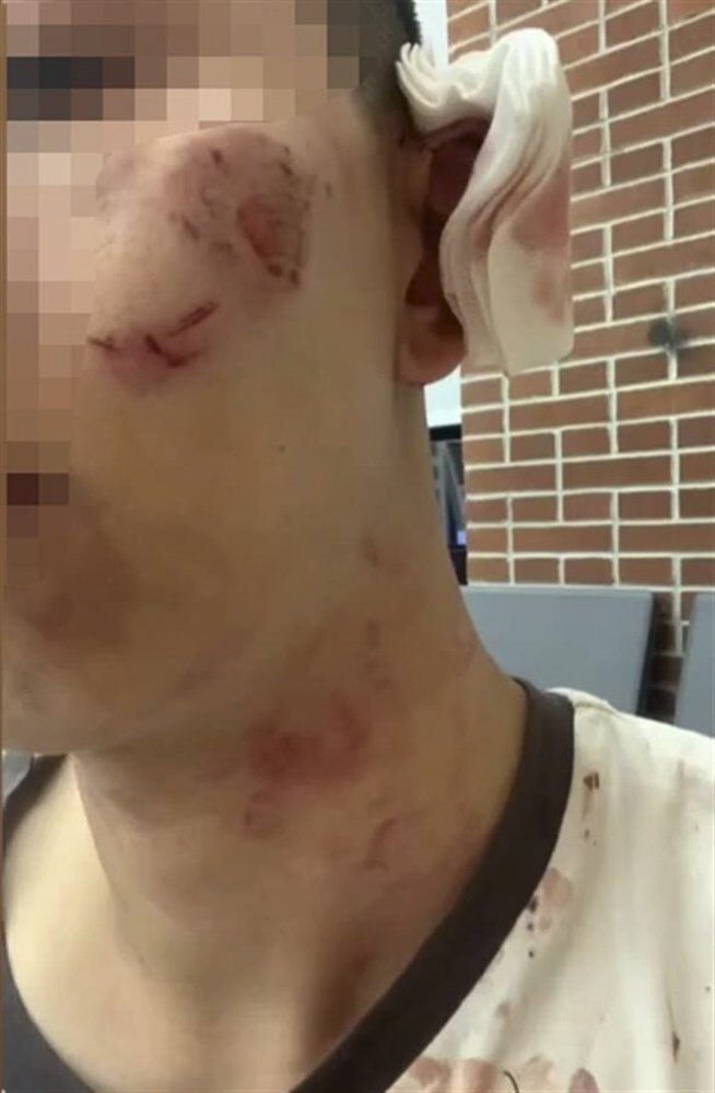 Nam thanh niên bị thương sau vụ đánh ghen nhầm.