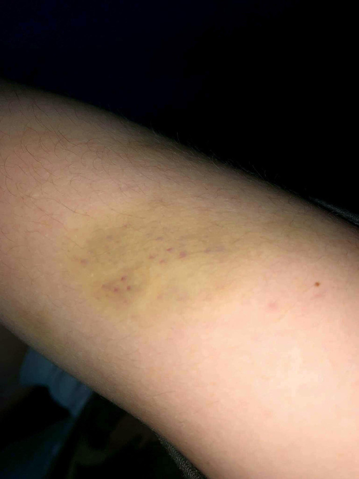 Vết bầm trên người B.X.