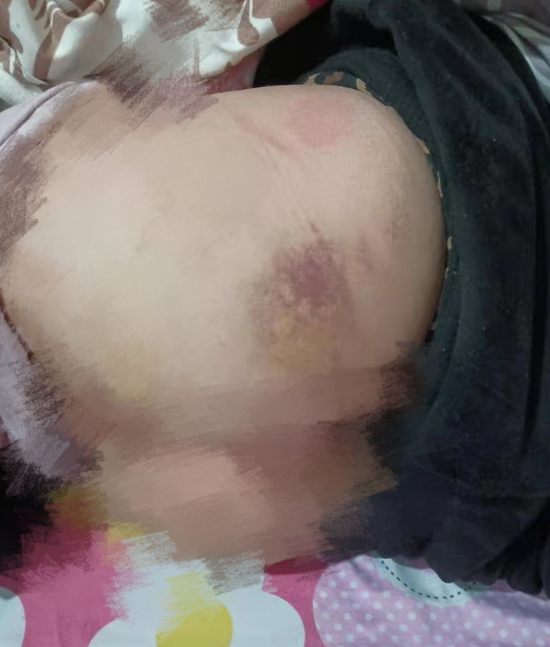 Trên người nữ sinh có nhiều vết bầm tím sau khi bị thầy hiệu trưởng đánh.  Ảnh: Sina.