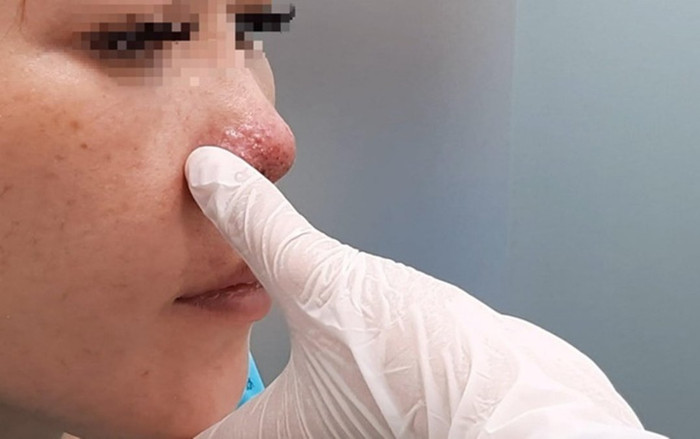Cô gái 'tá hỏa' khi vùng mũi miệng tím bầm, biến dạng sau 3 ngày tiêm filler ở spa Ảnh 2