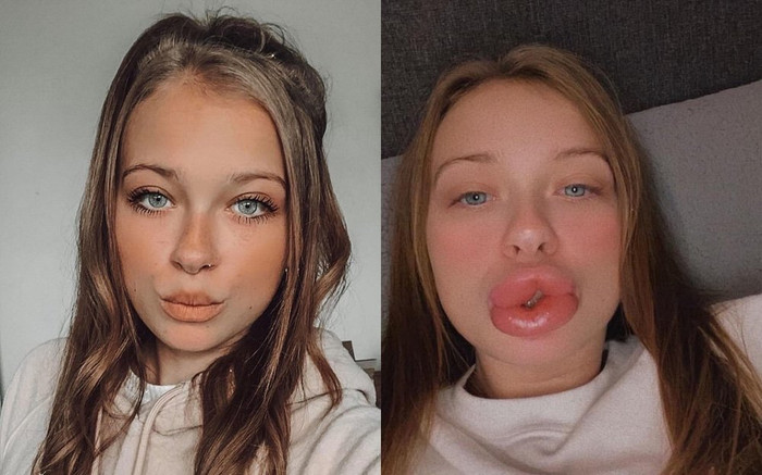 Ham tiêm filler giá rẻ, người phụ nữ nhận về đôi môi sưng phồng biến dạng Ảnh 2