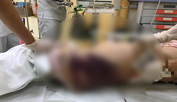 Cơ thể bé gái có nhiều vết bầm tím trên diện rộng