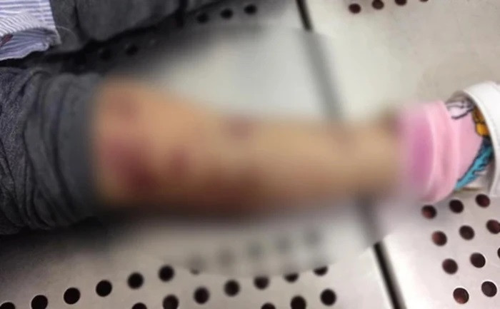 Cơ thể bé A. có nhiều vết bầm tím.