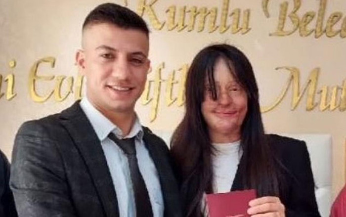 Bị bạn trai tạt axit, 2 năm sau cô gái có quyết định gây sốc cả đất nước Ảnh 2