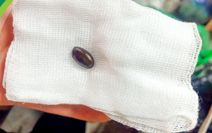 Bé trai nguy kịch do sặc hạt na được cứu sống kịp thời Ảnh 2