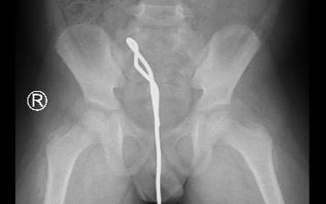 Bé trai 6 tuổi nhét thanh sắt thông cống vào hậu môn, nguyên nhân khiến tất cả hoang mang Ảnh 2