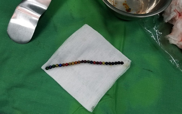 Bé trai 37 tháng tuổi ở Nghệ An nuốt phải 25 viên bi nam châm vào ổ bụng Ảnh 2