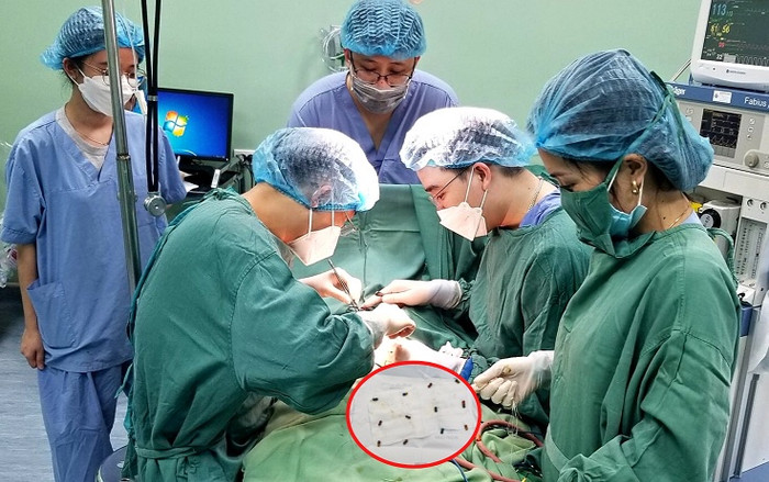 Bé trai 37 tháng tuổi, nuốt phải 25 viên bi nam châm được cấp cứu kịp thời Ảnh 2