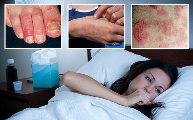 3 triệu chứng phát ban cảnh báo nguy cơ nhiễm biến thể Omicron Ảnh 2