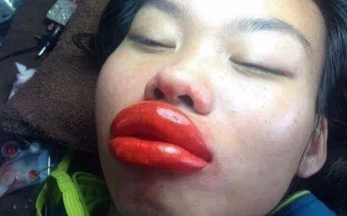 'Độ' môi xinh đón Tết, cô gái nhận về cái kết đắng, sưng tấy như ong chích Ảnh 2