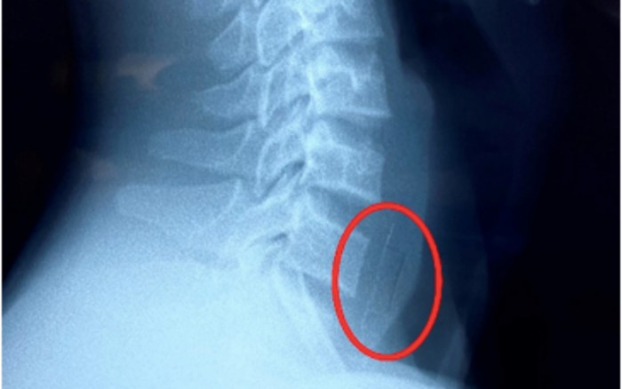 Cấp cứu khẩn bé trai nhập viện do nuốt viên thuốc hạ sốt còn nguyên vỏ Ảnh 2