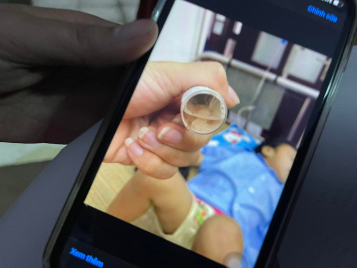Dị vật trong mũi cháu Ngọc A.