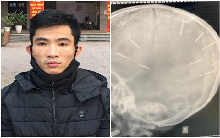 Hà Nội hoả tốc chỉ đạo vụ bé gái 3 tuổi bị bạo hành với 9 dị vật trong sọ não nghi là đinh Ảnh 2