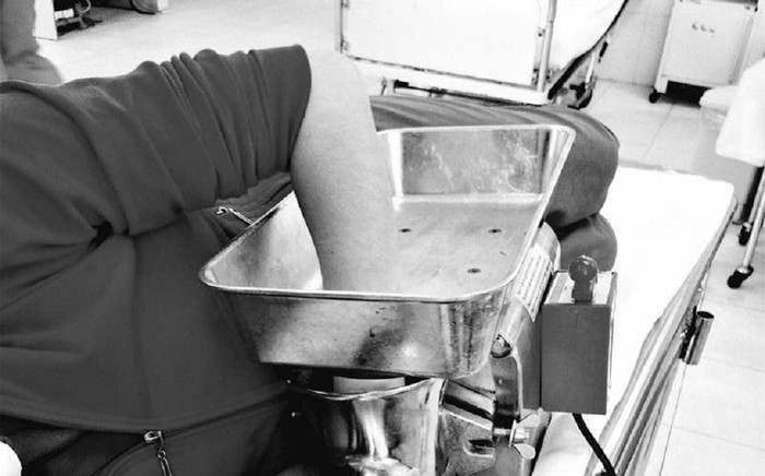 Người phụ nữ bị máy xay thịt 'nuốt' bàn tay, không thể nối các ngón tay bị đứt Ảnh 2