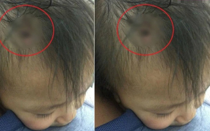 Sự thật bức ảnh được cho là của bé gái 3 tuổi ở Hà Nội với chiếc đinh găm thẳng vào đầu gây xôn xao MXH Ảnh 2