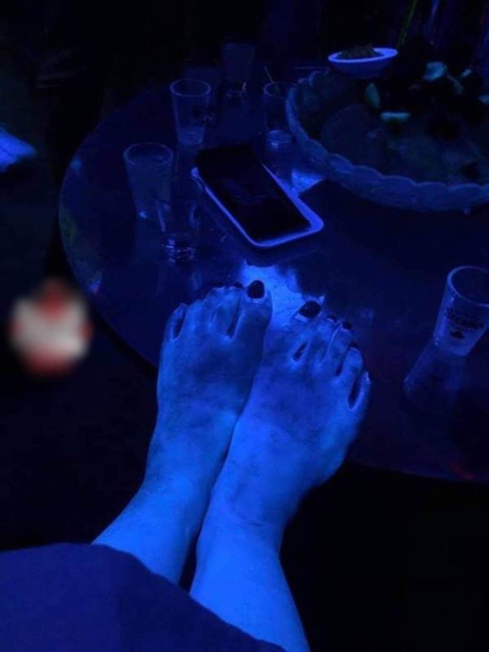 Chân tay cô gái phát sáng loang lổ khiến chỉ vì thoa mỹ phẩm 