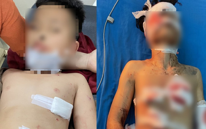 Sau tiếng nổ lớn nghi do pháo tự chế phát nổ, 4 học sinh bị thương nặng Ảnh 2