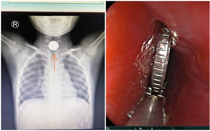 Cấp cứu thành công ca mắc dị vật cổ họng ngày Mùng 1 Tết Ảnh 2