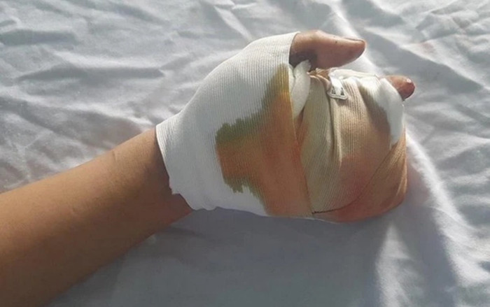 Cấp cứu khẩn thiếu niên bị dập nát bàn tay vì pháo tự chế Ảnh 2