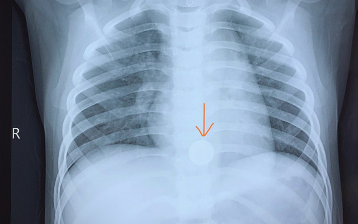 Cứu sống bé trai 5 tuổi mắc dị vật pin cúc áo, bác sĩ đưa ra lời khuyên đáng lưu ý cho bố mẹ Ảnh 2