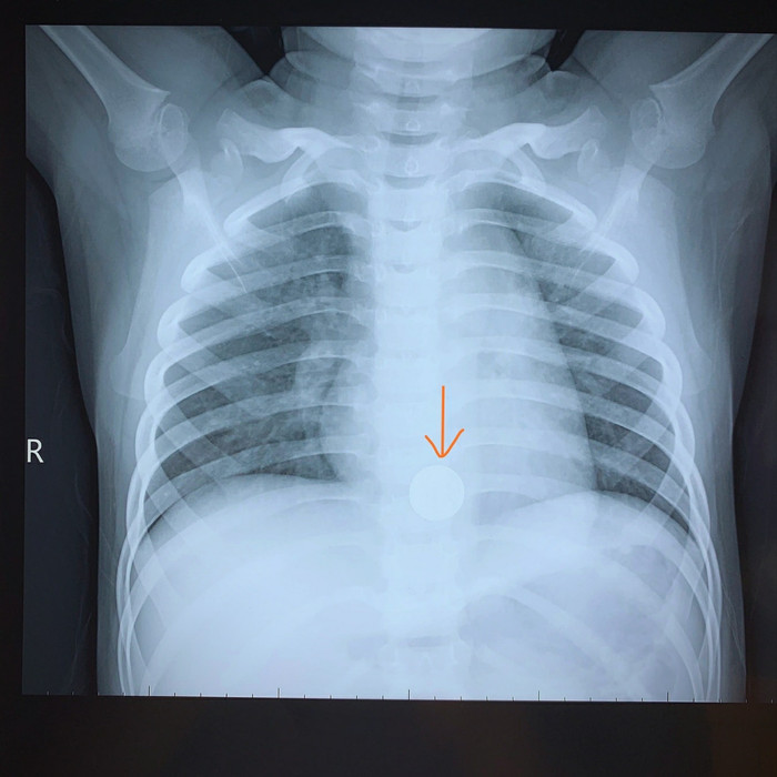 Dị vật pin cúc áo trong người bé trai 5 tuổi