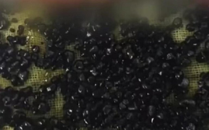 485 viên sỏi được lấy ra từ túi mật thanh niên 28 tuổi, nguyên nhân từ thói quen nhiều người mắc phải Ảnh 2