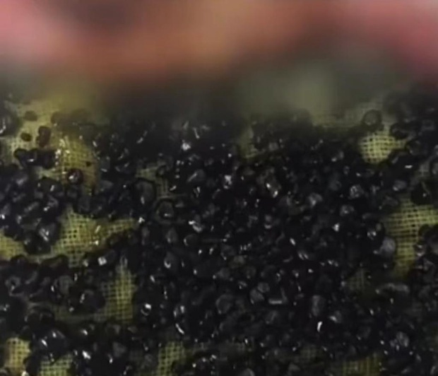 485 viên sỏi được lấy ra từ túi mật thanh niên 28 tuổi, nguyên nhân từ thói quen nhiều người mắc phải Ảnh 3