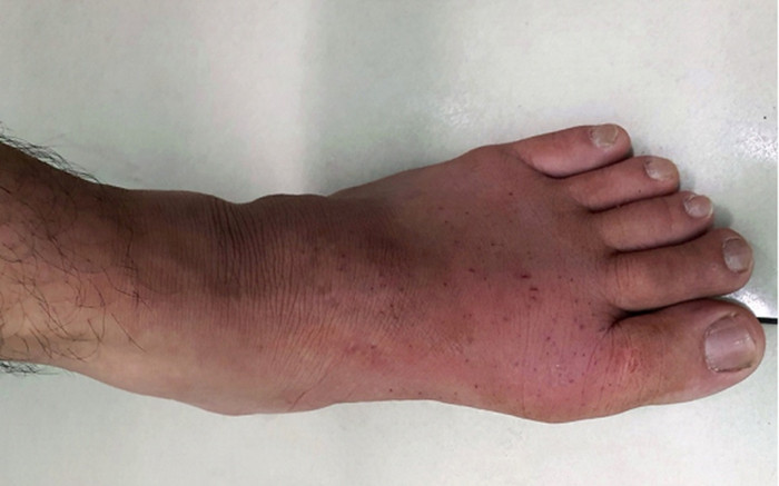 Vì sao nhiều người phát bệnh gút hoặc bị nặng lên sau kỳ nghỉ Tết? Ảnh 2