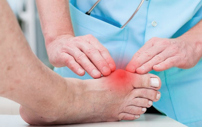 Cần làm gì để phòng chống bệnh gút tái phát trong dịp lễ và bệnh tấn công sau Tết? Ảnh 2