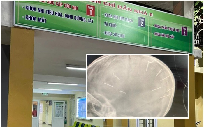 Vụ bé 3 tuổi bị găm đinh vào đầu: Tiên lượng sức khỏe rất nặng Ảnh 2