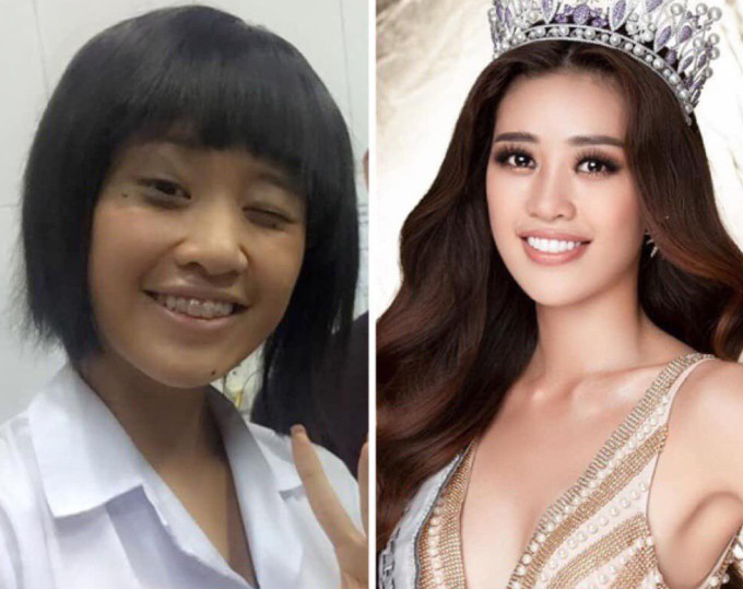 Khánh Vân là hoa hậu 'đổi đời' nhờ xử lý hàm răng, cô đã niềng răng từ khi đi học.