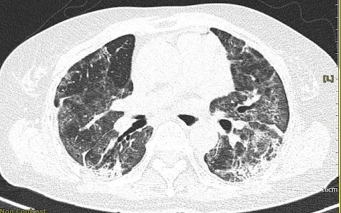 Cẩn thận với bệnh xơ phổi, phổi trắng xóa gây khó thở hậu Covid-19 Ảnh 2