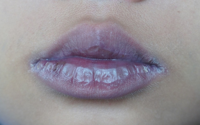 Thấy dấu hiệu này trên môi, F0 nhiễm Omicron phải vào viện ngay lập tức Ảnh 2