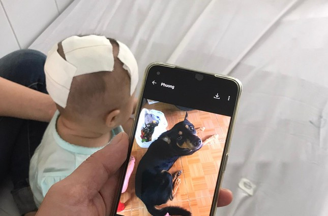Bé gái bị chó cưng của nhà cắn xuyên sọ.