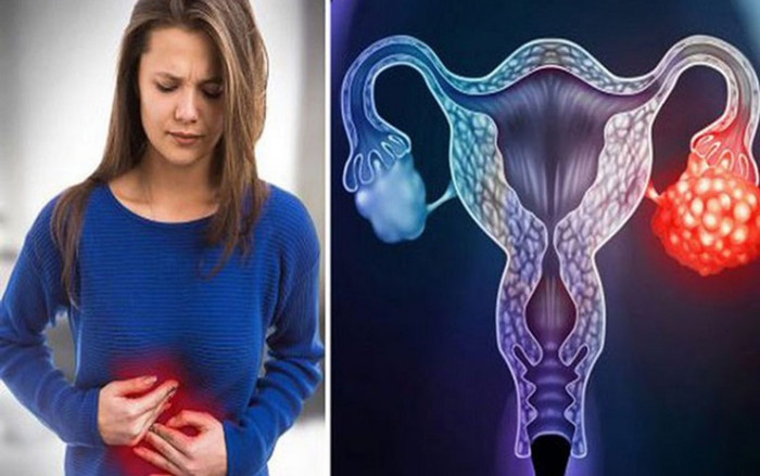 Hãy nghĩ ngay đến ung thư buồng trứng khi thấy những dấu hiệu này Ảnh 2