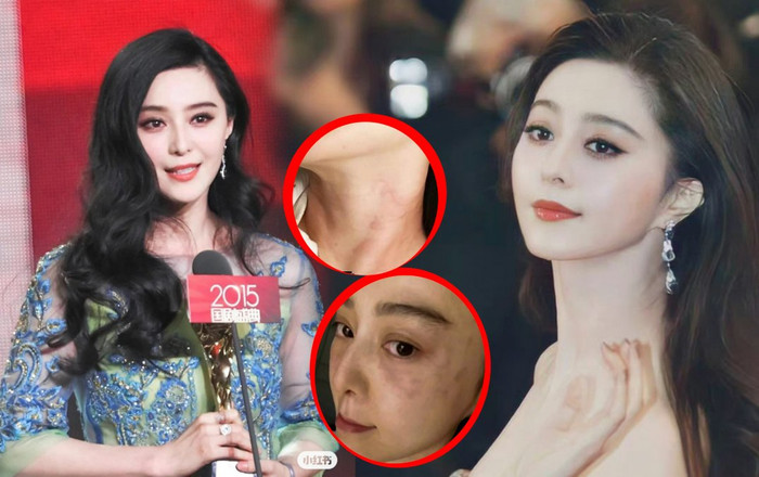 Phạm Băng Băng lộ vết bầm đen khắp cổ, mặt sưng húp, khiến fan lo lắng Ảnh 2