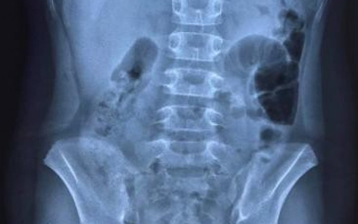 3 bệnh nhi mắc Covid-19 bị thủng dạ dày Ảnh 2