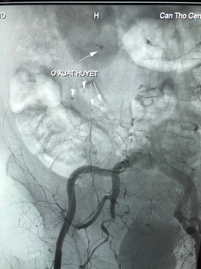 Hình ảnh xuất huyết trước can thiệp.