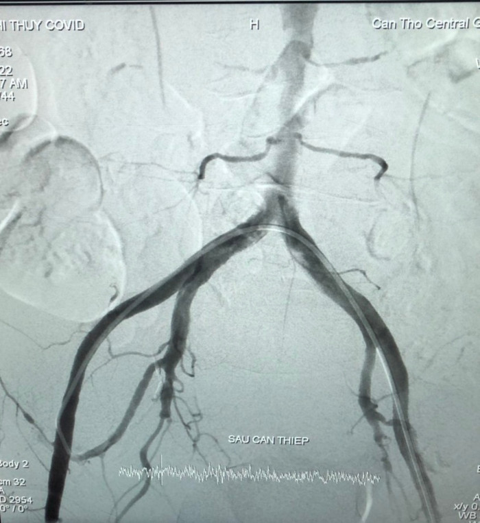 Hình ảnh sau can thiệp.