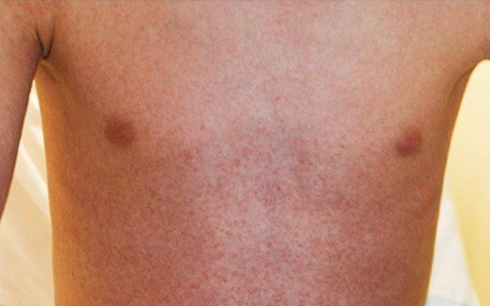 Dị ứng thuốc nguy hiểm thế nào? Ảnh 2