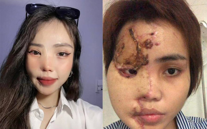 Sau 3 năm, cô gái bị chồng sắp cưới tạt axit giờ ra sao? Ảnh 2