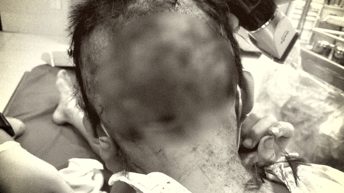 Bé trai bị chó tấn công gây vết thương lớn vùng đầu. Ảnh: VTV