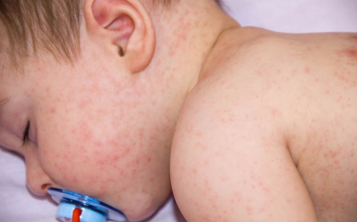 Trẻ mắc Covid-19 kèm phát ban, phụ huynh có cần quá lo lắng? Ảnh 2